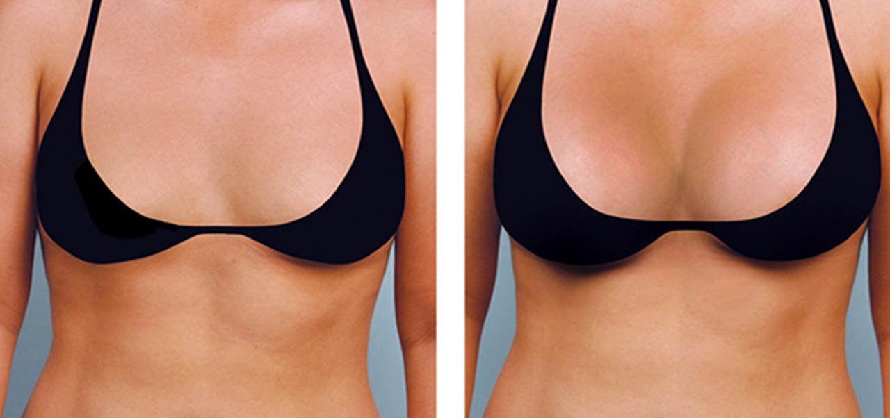 Things You Need To Know About Breast Lift Before And After Surgery In  Danville